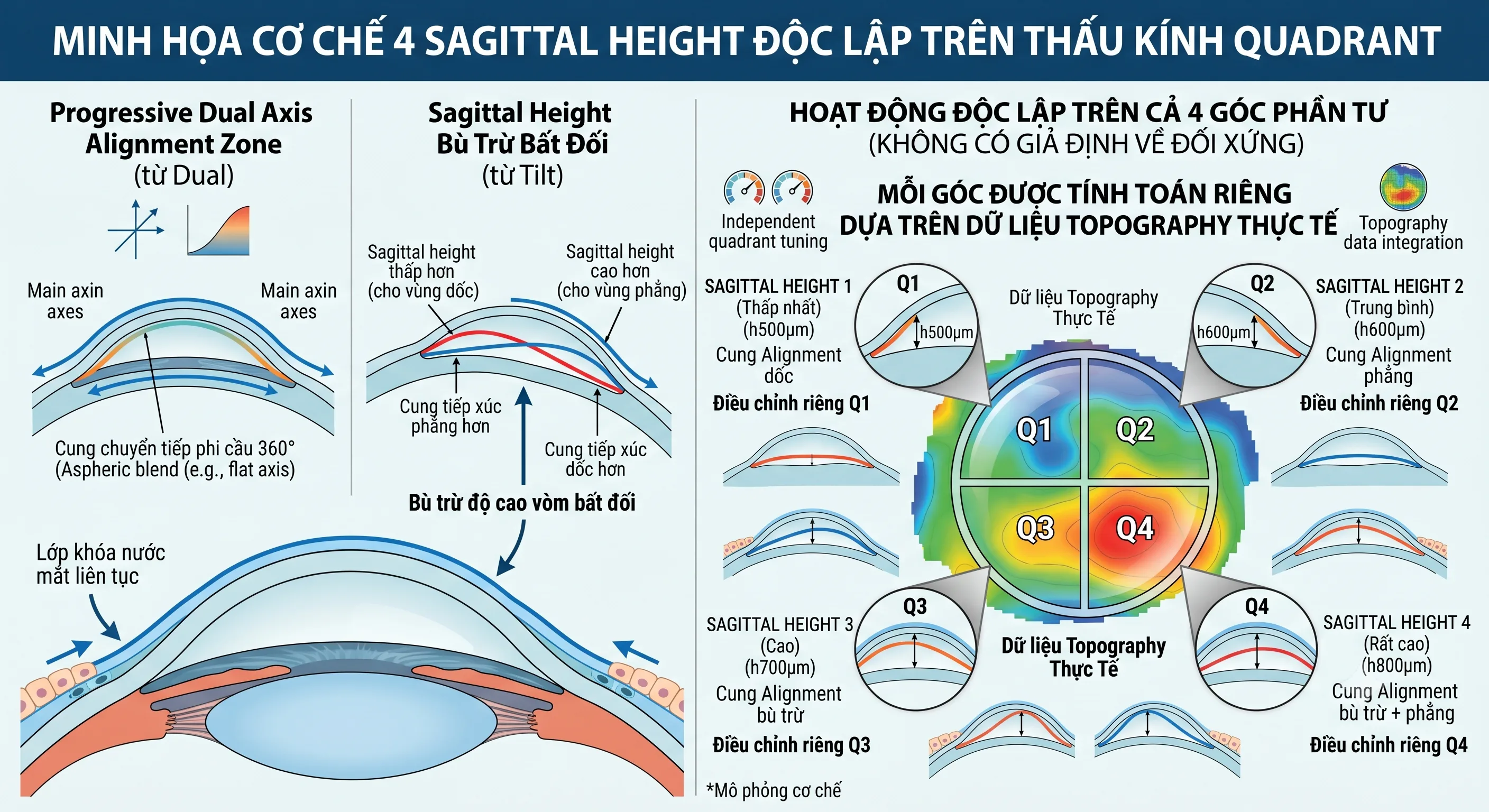 Cơ chế GOV® Quadrant — 4 sagittal height độc lập